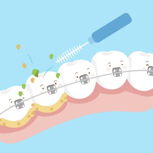 Brush and clean teeth with braces