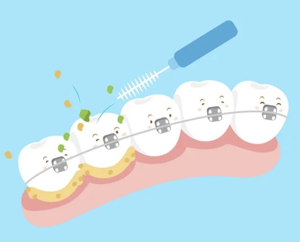 Brush and clean teeth with braces