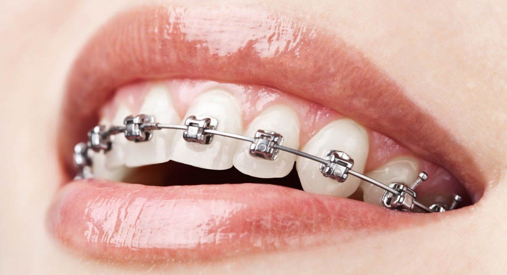 metal braces for adults
